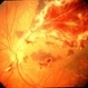 CMV Retinitis in a Patient with the Diagnosis of  AIDS